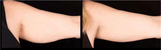 a close-up of a woman's arm
