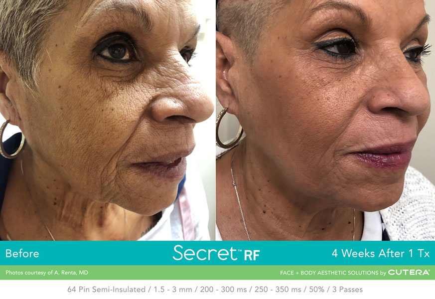 a woman with wrinkles and a face