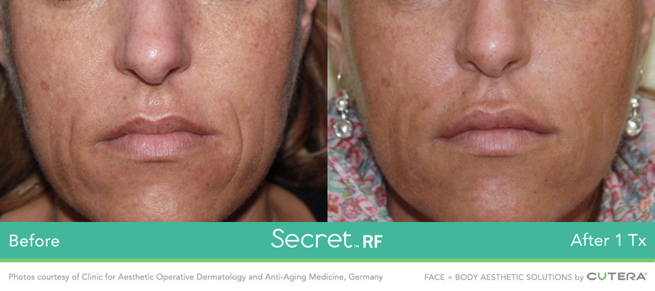 a woman's face before and after
