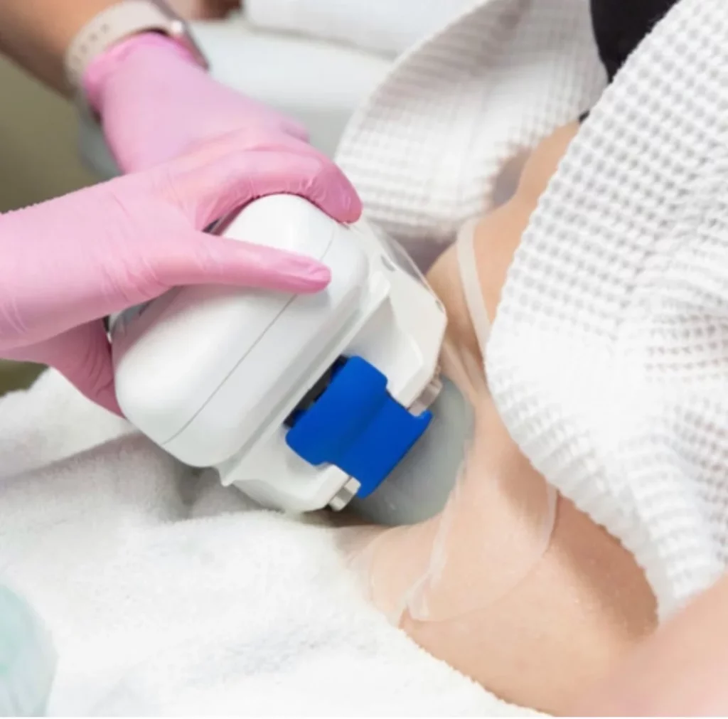 CoolSculpting in New York, NY