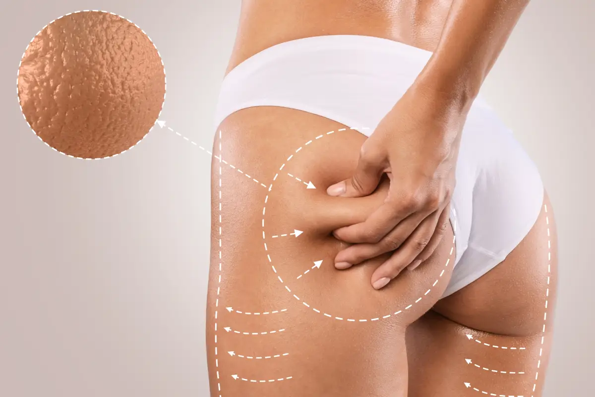 Cellulite Inglo Med spa New York NY