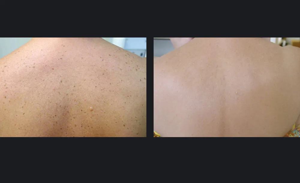 gentlemax-sun-spots-christine-mansur-md-p1.jpg