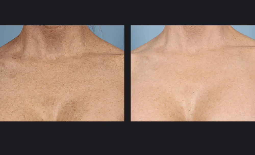 gentlemaxpro-plus-benign-pigmented-lesions-candela-3tx-p1.jpg